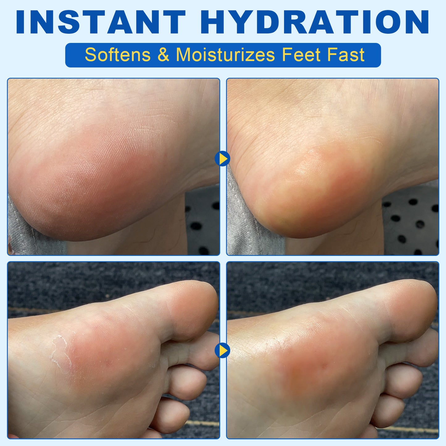 60% Urea 2% Salicylic Acid Foot Stick Cracked Repair Product Exfoliation Dead Skin Removal Softening Moisturize Smooth Skin Care