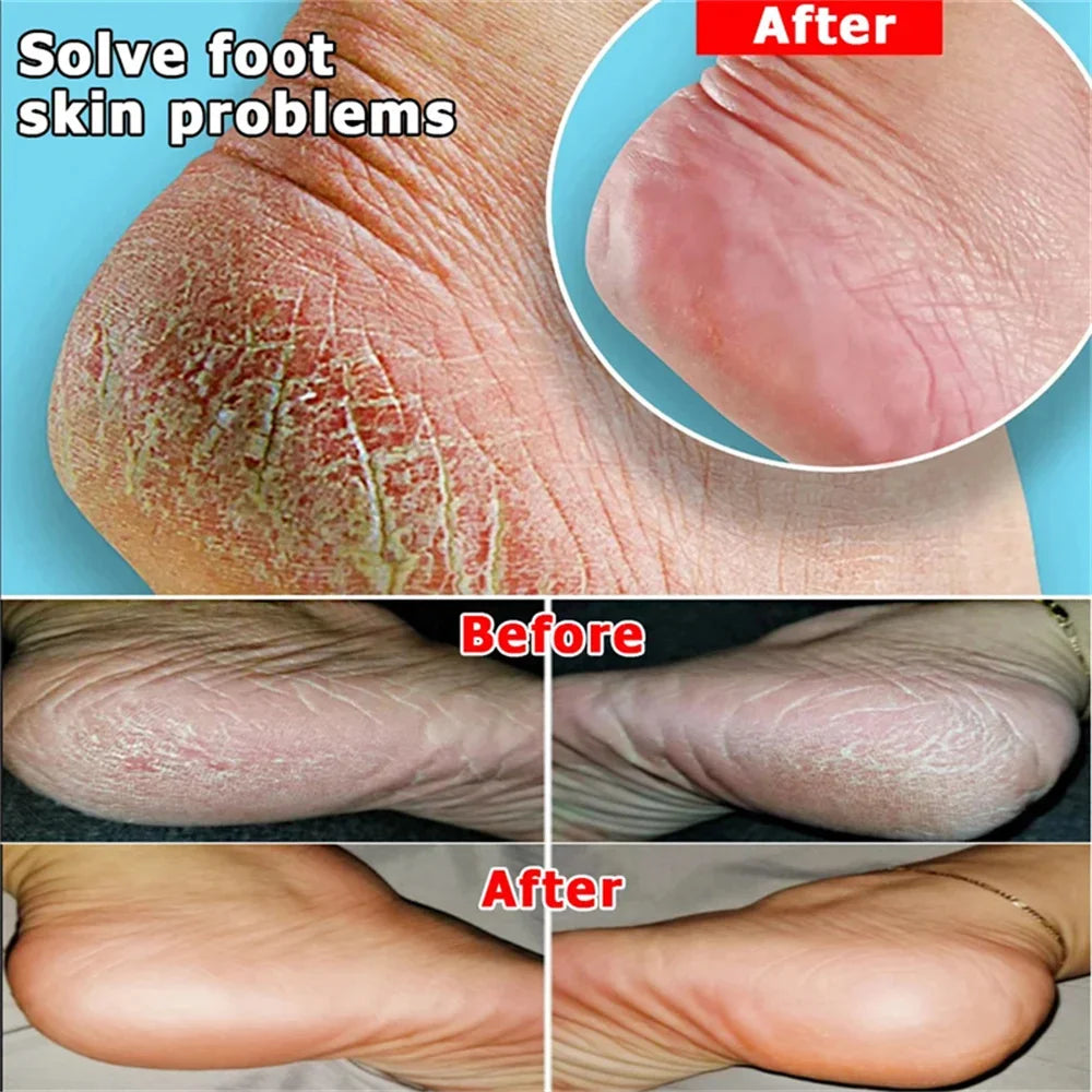 60% Urea 2% Salicylic Acid Foot Stick Cracked Repair Product Exfoliation Dead Skin Removal Softening Moisturize Smooth Skin Care