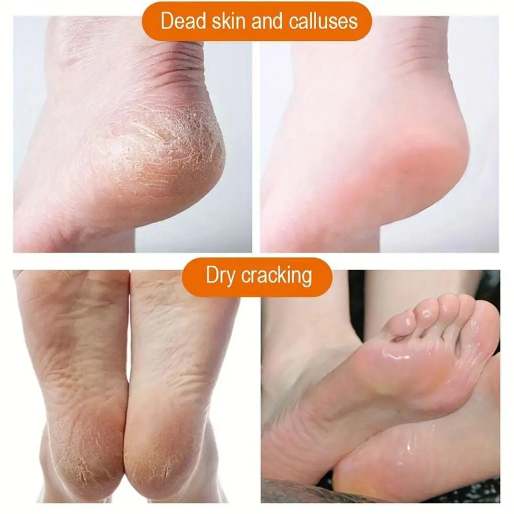 60% Urea 2% Salicylic Acid Foot Stick Cracked Repair Product Exfoliation Dead Skin Removal Softening Moisturize Smooth Skin Care