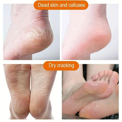 60% Urea 2% Salicylic Acid Foot Stick Cracked Repair Product Exfoliation Dead Skin Removal Softening Moisturize Smooth Skin Care