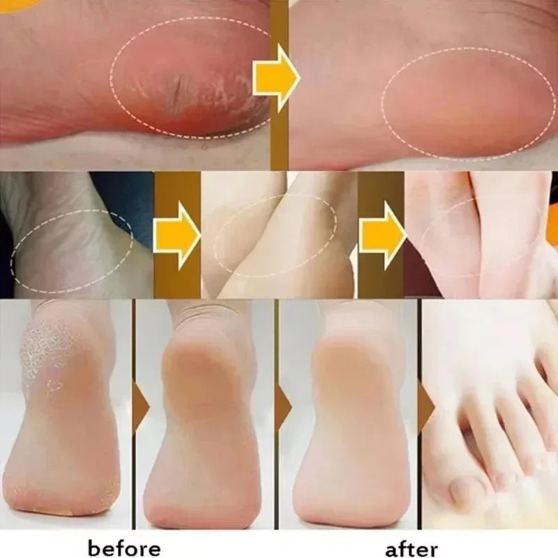 60% Urea 2% Salicylic Acid Foot Stick Cracked Repair Product Exfoliation Dead Skin Removal Softening Moisturize Smooth Skin Care