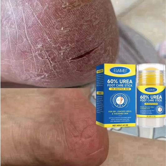 60% Urea 2% Salicylic Acid Foot Stick Cracked Repair Product Exfoliation Dead Skin Removal Softening Moisturize Smooth Skin Care